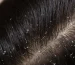 Learn-difference-between-White-piedra-and-Dandruff.jpg